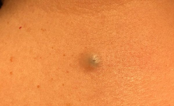 U nang biểu bì là gì? Điều trị bằng cách nào?