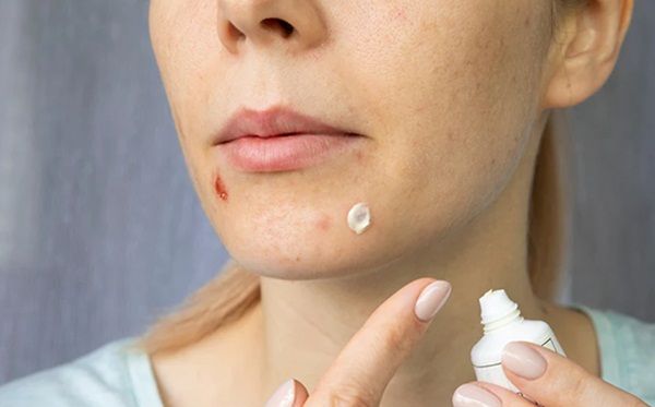 Cách chăm sóc vảy mụn để không bị sẹo