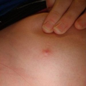 Tình trạng đau nhức nhối và đùn lên hột đỏ sau nâng ngực là bị sao ạ?