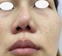 Sóng mũi và đầu mũi đều bị lệch vẹo Sóng mũi và đầu mũi đều bị lệch vẹo