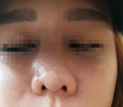 mũi bị nghiêng sang 1 bên và bị sưng to sau nâng mũi