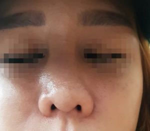 mũi bị nghiêng sang 1 bên và bị sưng to sau nâng mũi