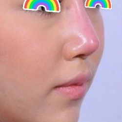 Cách khắp phục tình trạng mũi có hiện tượng bị nhọn đầu?