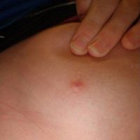 Ngực bị đau sau 2 năm nâng ngực