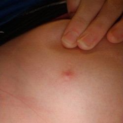 Ngực bị đau sau 2 năm nâng ngực