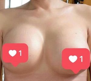 Cách xử lý nâng ngực bị tụt xuống