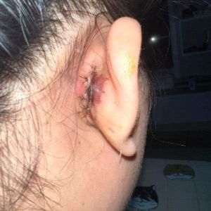 Nâng mũi sụn thấy ngứa ở phần sau tai