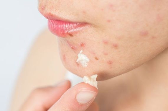 Tìm hiểu cơ chế trị mụn trứng cá của retinol