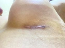 Khắp phục sẹo lồi sau nâng ngực?