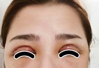 Hiện tượng mưng mủ và sưng phù sau cắt mí