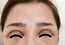 Hiện tượng mưng mủ và sưng phù sau cắt mí