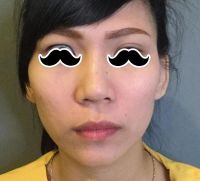 Khắc phục mắt bị trợn sau cắt mí?