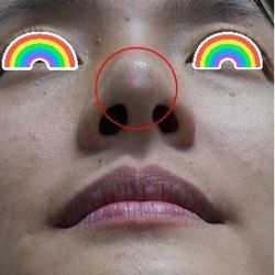 mũi em bị tụt xuống và bị mỏng da đầu mũi sau nâng mũi 2 năm