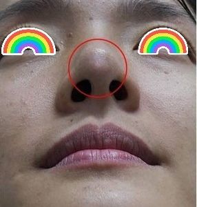 mũi em bị tụt xuống và bị mỏng da đầu mũi sau nâng mũi 2 năm