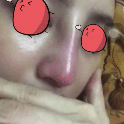 Tình trạng mũi sưng đỏ hơn sau nâng mũi