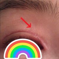 Điều trị sẹo ở góc mắt sau cắt mí?