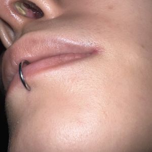 Chào bác sĩ, em nâng mũi cấu trúc sụn tai, mổ kín, được gần 1 tháng. Chỗ vết mổ sau đó có đóng mài đỏ, sau khi vệ sinh thì lớp mài đỏ đã hết, nhưng em lại thấy một lớp vảy màu trắng, dù đã vệ sinh sạch sẽ và thoa thuốc mỡ tetra hàng ngày nhưng mãi vẫ