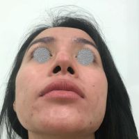 Sửa mũi chỗ đầu mũi bị sưng sau 1 tháng và có dấu hiệu bị lệch Sửa mũi chỗ đầu mũi bị sưng sau 1 tháng và có dấu hiệu bị lệch