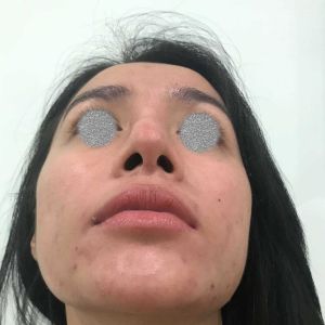 Sửa mũi chỗ đầu mũi bị sưng sau 1 tháng và có dấu hiệu bị lệch