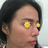 Đầu mũi cụp xuống sau nâng mũi 3 tháng Đầu mũi cụp xuống sau nâng mũi 3 tháng