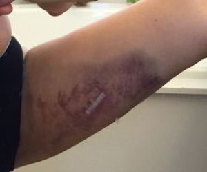 Xuất hiện vết bầm tím ở đùi sau hút mỡ