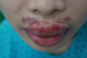 Môi bị sưng phồng, bầm tím sau khi tiêm filler