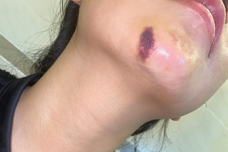 Tiêm filler cằm được vài tuần thì bị bầm tím phải làm sao? Tiêm filler cằm được vài tuần thì bị bầm tím phải làm sao?