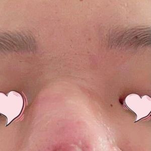 Cách nào sửa mũi nâng bị thủng không để lại sẹo?