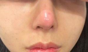 Mũi nâng bị đỏ và sưng nhiều, uống kháng sinh có chữa được không?