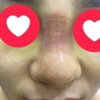 Giải quyết mũi bị sưng do va đập Giải quyết mũi bị sưng do va đập
