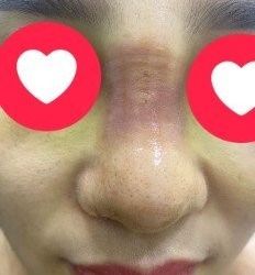 Giải quyết mũi bị sưng do va đập