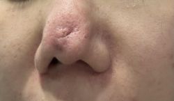 Nâng mũi bị viêm nặng và cách phục hồi?