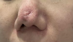 Nâng mũi bị viêm nặng và cách phục hồi?