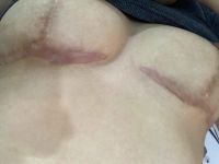 Xử lý sẹo sau treo mỏ neo