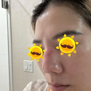 Mũi sụn sườn bị viêm, tháo ra có bị co rút