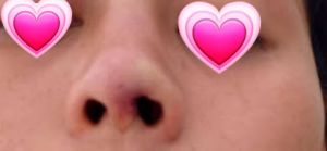 Rút sụn mũi ra có bị co rút hay lõm không?