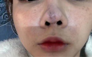 Nâng mũi vài tháng thì mũi bắt đầu sưng nề lên tím ngắt