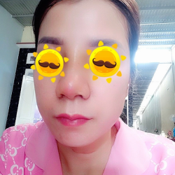 Mũi làm 20 ngày vẫn còn sưng húp