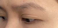 Chào bác sĩ,
Tôi cắt mí được 1 năm, mà đuôi mí 1 bên bị chia thành 2 đuôi. Tôi muốn sửa lại, phương pháp nào là tốt nhất ạ?