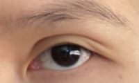 Chào bác sĩ,
Tôi cắt mí được 1 năm, mà đuôi mí 1 bên bị chia thành 2 đuôi. Tôi muốn sửa lại, phương pháp nào là tốt nhất ạ?