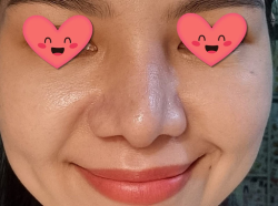 Đầu mũi bị vẹo sau khi nâng