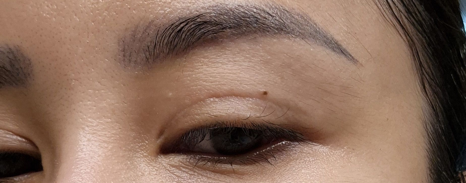 Cắt mí đã 1 năm rưỡi nhưng vẫn có seho xấu và mí mắt vẫn hơi sưng Cắt mí đã 1 năm rưỡi nhưng vẫn có seho xấu và mí mắt vẫn hơi sưng