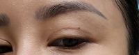 Cắt mí đã 1 năm rưỡi nhưng vẫn có seho xấu và mí mắt vẫn hơi sưng
