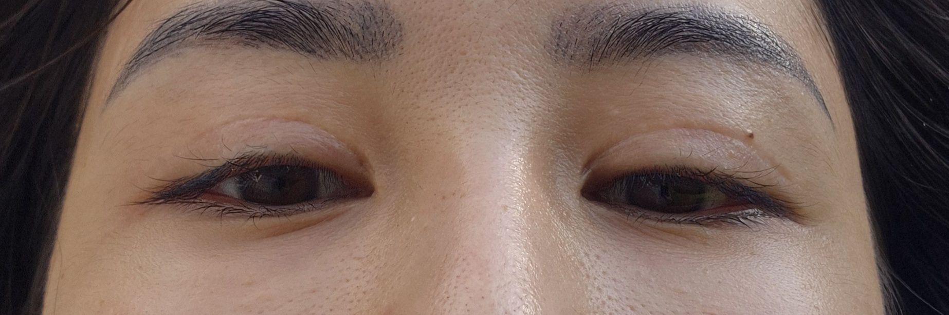 Cắt mí đã 1 năm rưỡi nhưng vẫn có seho xấu và mí mắt vẫn hơi sưng Cắt mí đã 1 năm rưỡi nhưng vẫn có seho xấu và mí mắt vẫn hơi sưng