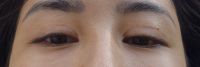 Cắt mí đã 1 năm rưỡi nhưng vẫn có seho xấu và mí mắt vẫn hơi sưng
