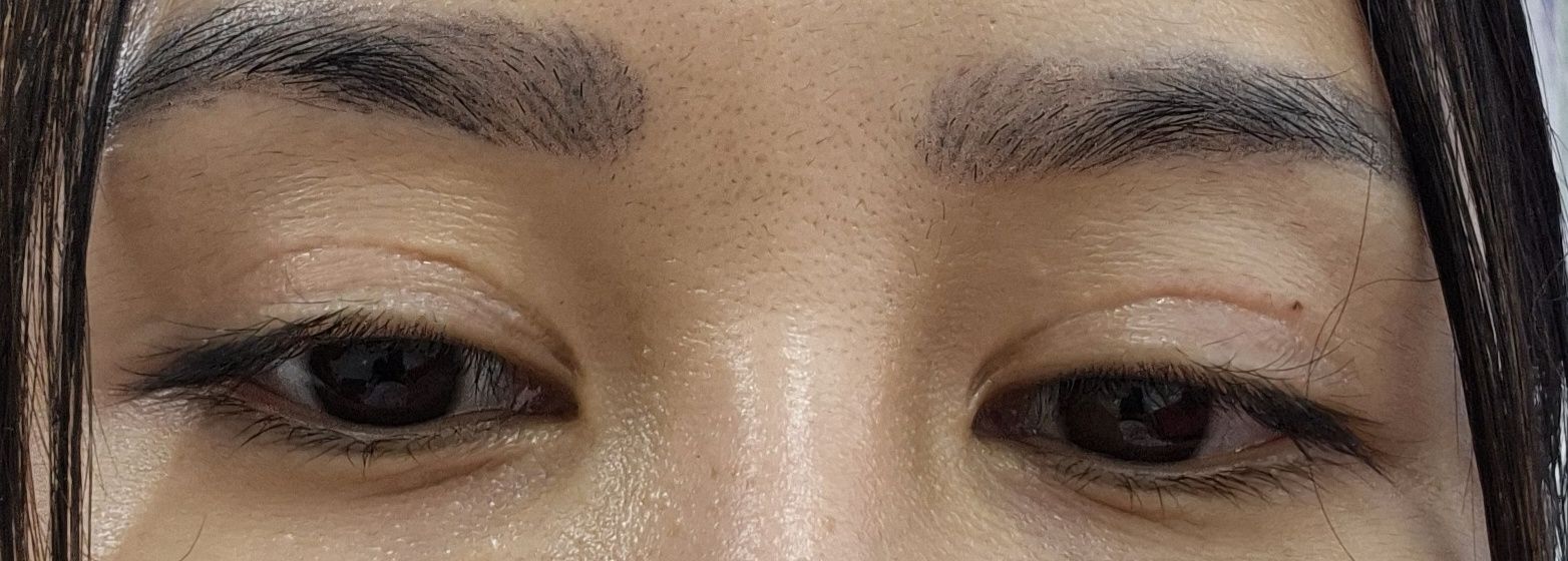 Cắt mí đã 1 năm rưỡi nhưng vẫn có seho xấu và mí mắt vẫn hơi sưng Cắt mí đã 1 năm rưỡi nhưng vẫn có seho xấu và mí mắt vẫn hơi sưng