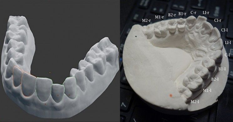 Niềng răng: tại sao hình ảnh 3D tốt hơn dấu răng thủ công?