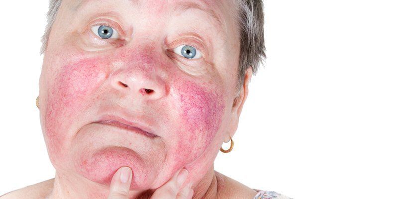 Phân loại 4 loại da nhạy cảm và cách điều trị