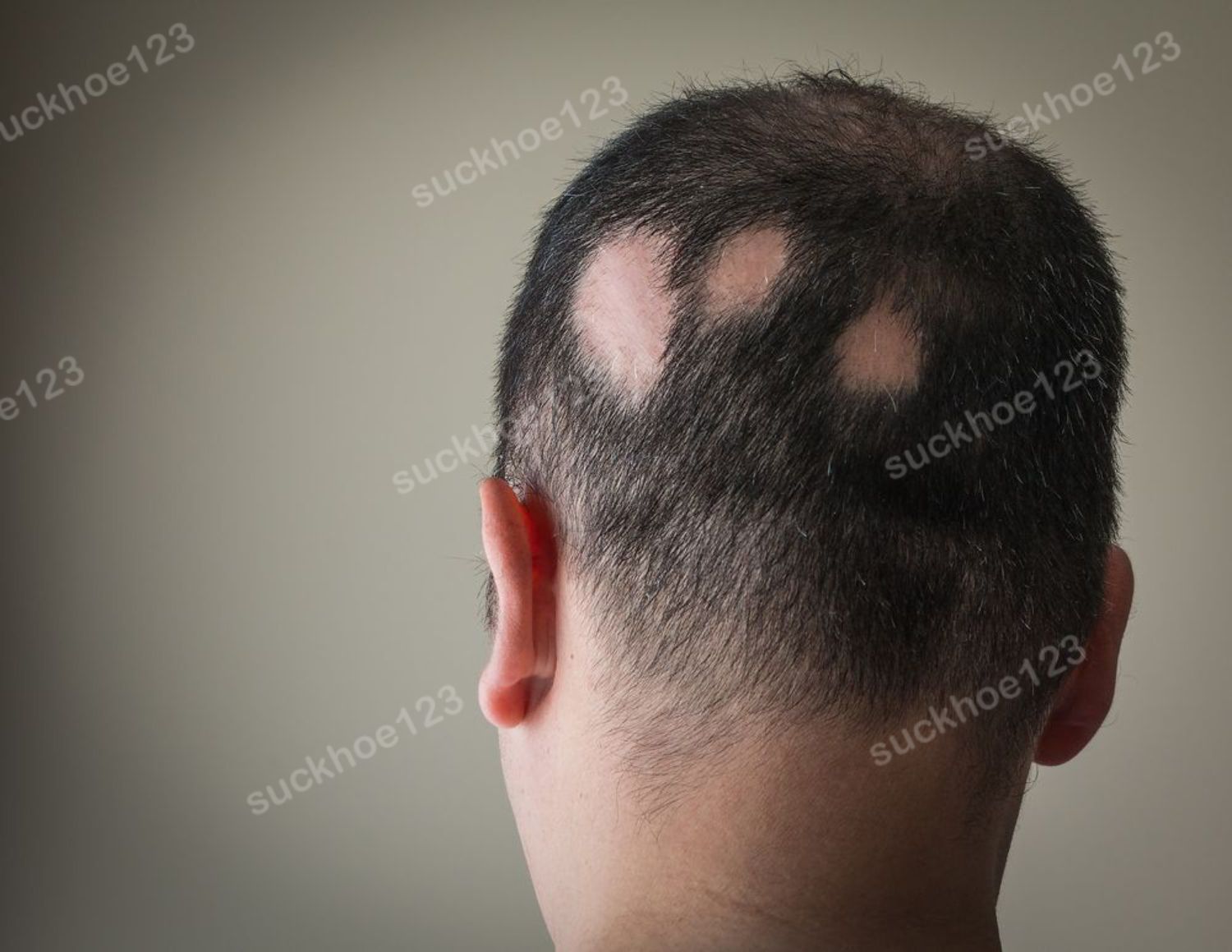 Rụng tóc từng mảng (Alopecia Areate)