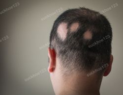 Rụng tóc từng mảng (Alopecia Areate)